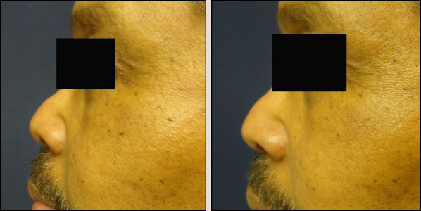 Chicago mole removal shave no scarring